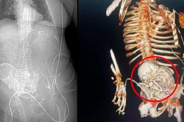 “Bebê de pedra”: Idosa descobre feto calcificado que carregou por 56 anos