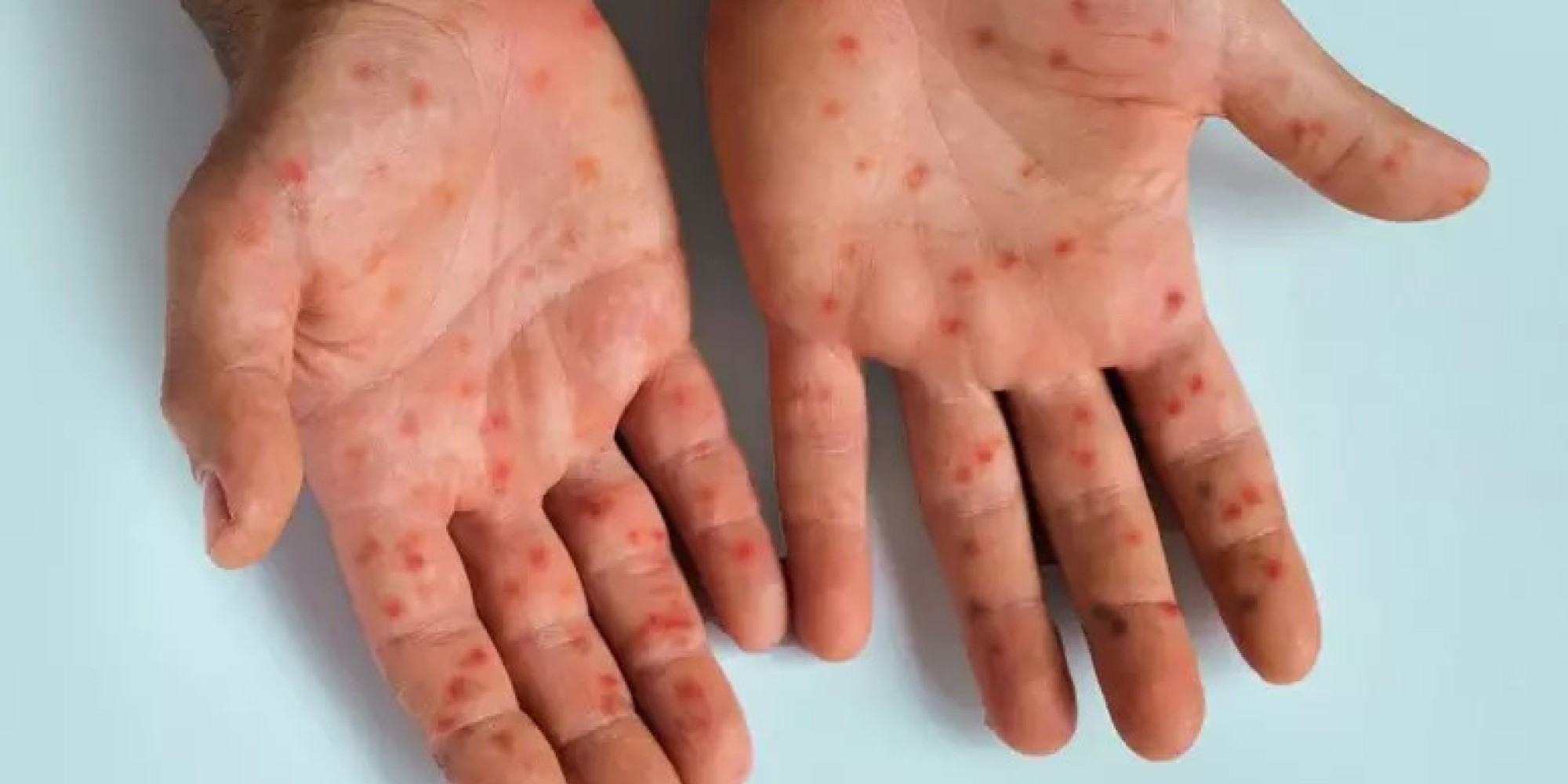 Secretaria da Saúde do RS emite alerta epidemiológico sobre a Mpox