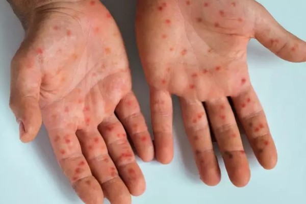 Secretaria da Saúde do RS emite alerta epidemiológico sobre a Mpox
